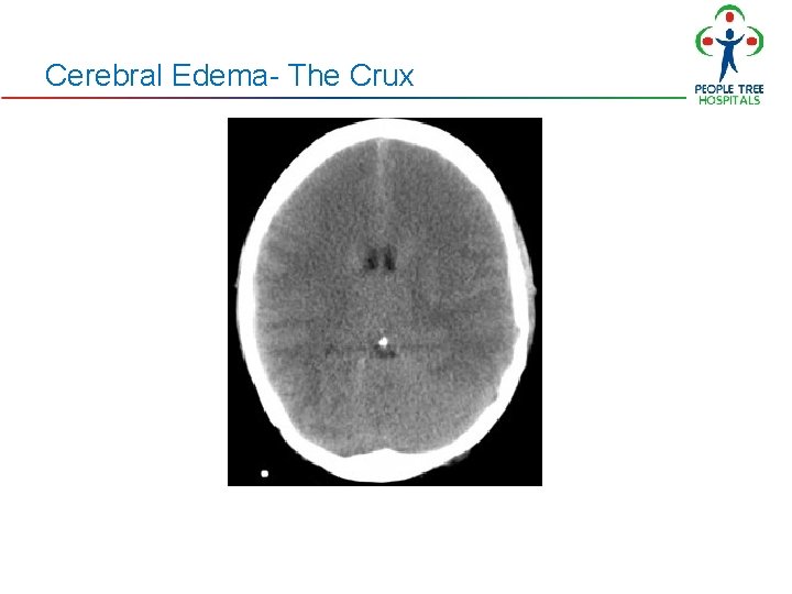 Cerebral Edema- The Crux Cerebral Edema- The Crux