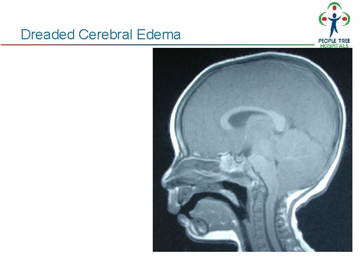 Dreaded Cerebral Edema Dreaded Cerebral Edema