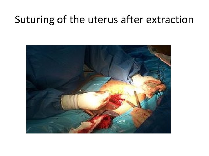 Suturing of the uterus after extraction 