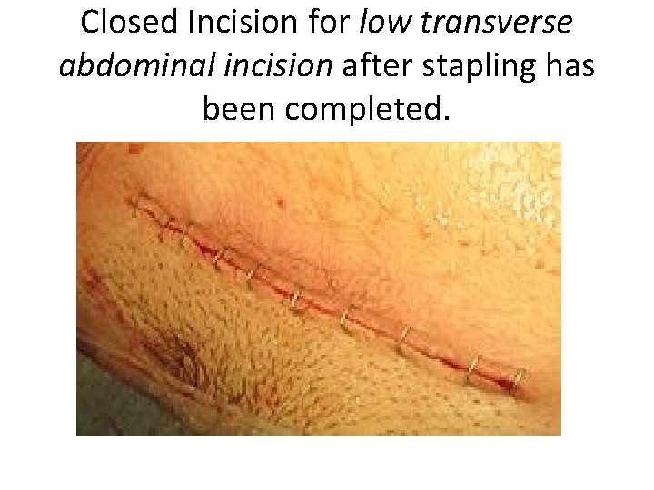 Closed Incision for low transverse abdominal incision after stapling has been completed. 