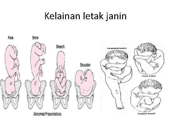 Kelainan letak janin 