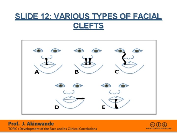 SLIDE 12: VARIOUS TYPES OF FACIAL CLEFTS 