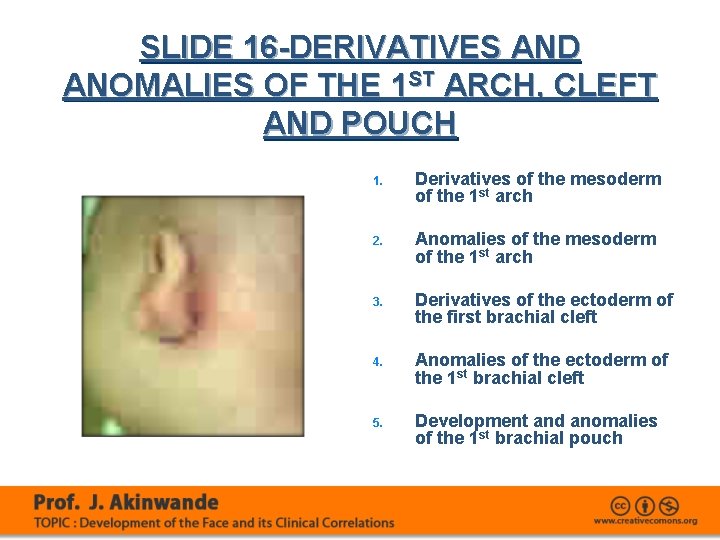 SLIDE 16 -DERIVATIVES AND ANOMALIES OF THE 1 ST ARCH, CLEFT AND POUCH 1.