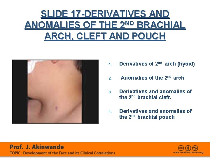 SLIDE 17 -DERIVATIVES AND ANOMALIES OF THE 2 ND BRACHIAL ARCH, CLEFT AND POUCH
