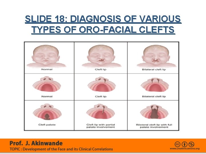 SLIDE 18: DIAGNOSIS OF VARIOUS TYPES OF ORO-FACIAL CLEFTS 