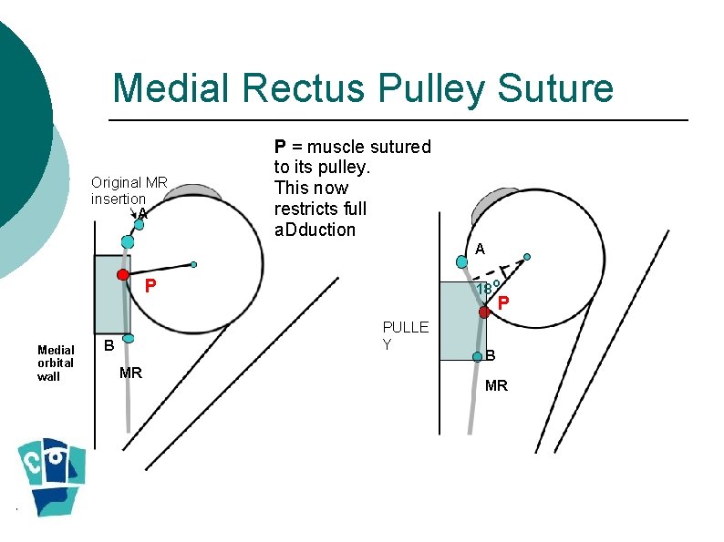 Medial Rectus Pulley Suture Original MR insertion A P = muscle sutured to its