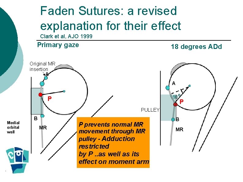 Faden Sutures: a revised explanation for their effect Clark et al, AJO 1999 Primary