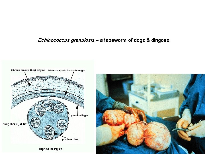 Echinococcus granulosis – a tapeworm of dogs & dingoes 