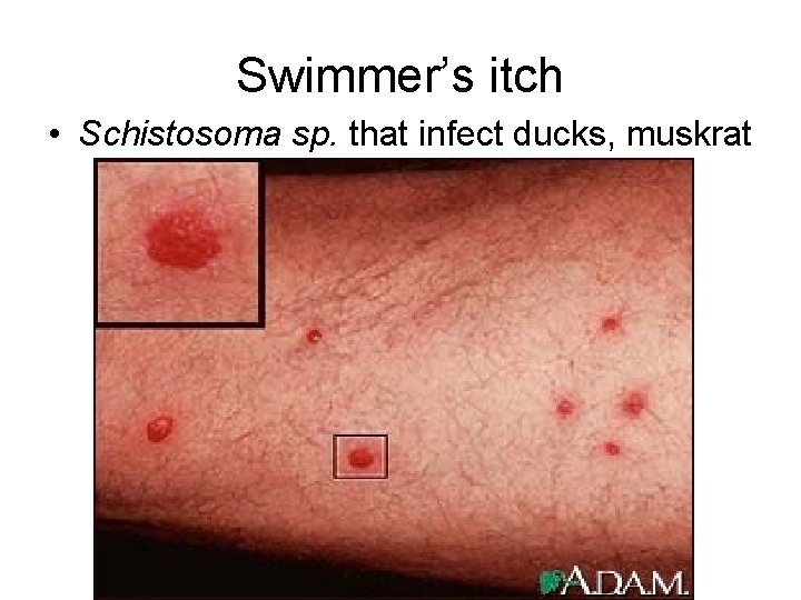 Swimmer’s itch • Schistosoma sp. that infect ducks, muskrat 