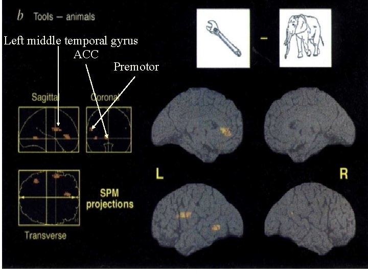 Left middle temporal gyrus ACC Premotor 