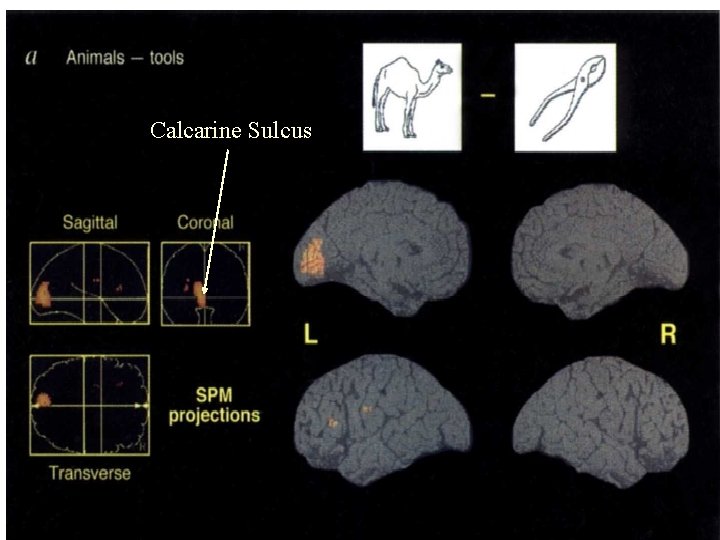 Calcarine Sulcus 