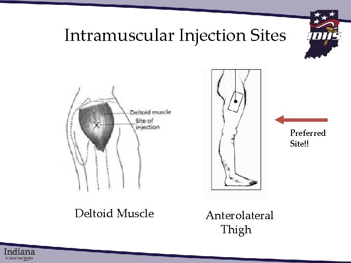 Intramuscular Injection Sites Preferred Site!! Deltoid Muscle Anterolateral Thigh 