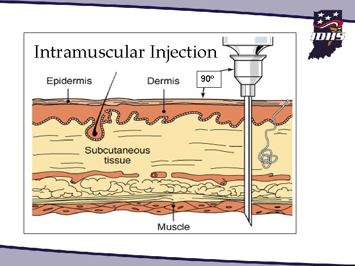 Intramuscular Injection 90º 