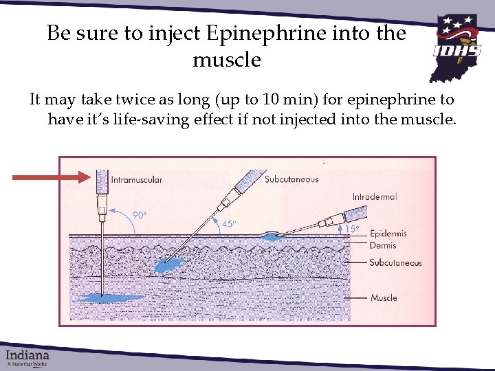 Be sure to inject Epinephrine into the muscle It may take twice as long