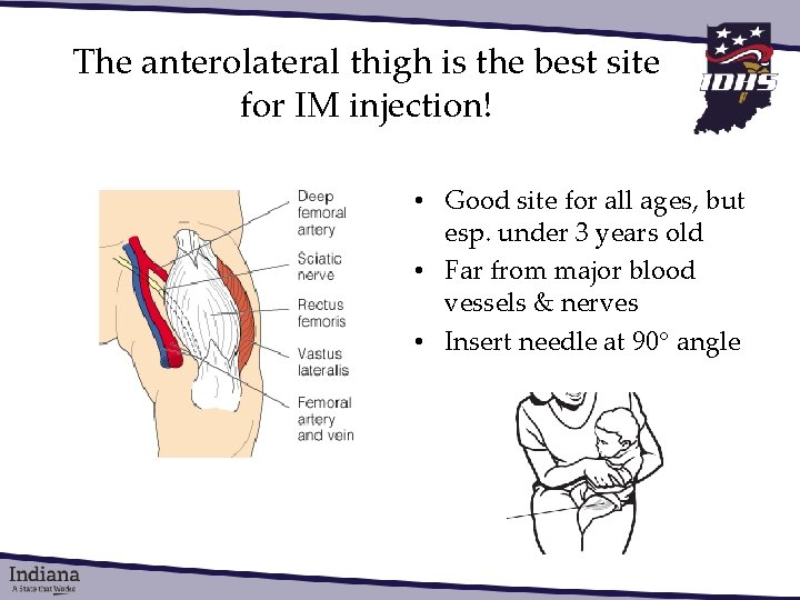 The anterolateral thigh is the best site for IM injection! • Good site for