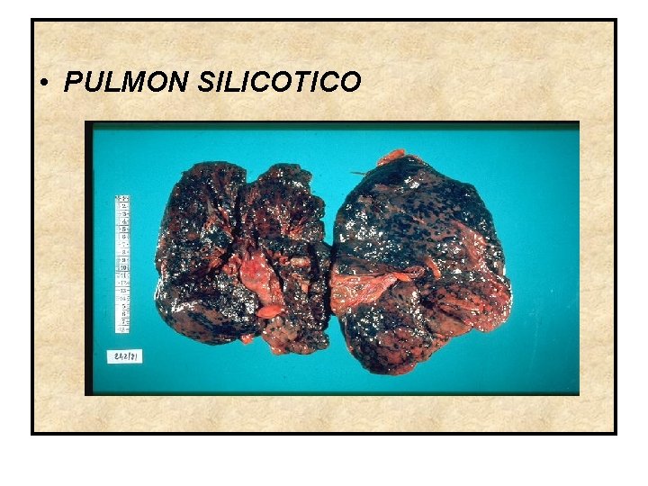  • PULMON SILICOTICO 