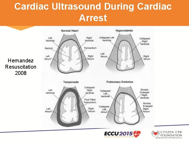 Cardiac Ultrasound During Cardiac Arrest Hernandez Resuscitation 2008 