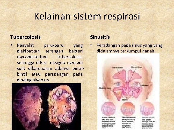 Kelainan sistem respirasi Tubercolosis Sinusitis • Penyakit paru-paru yang diakibatkan serangan bakteri mycobacterium tubercolosis.