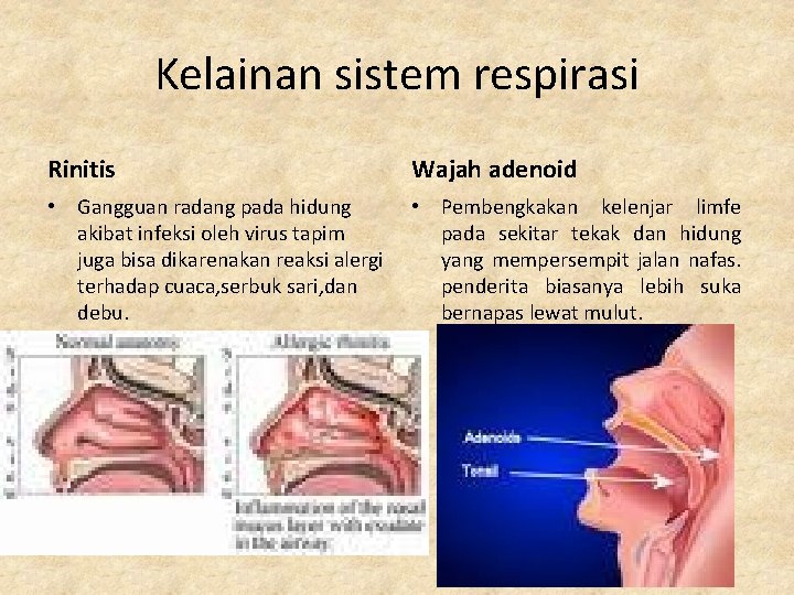 Kelainan sistem respirasi Rinitis Wajah adenoid • Gangguan radang pada hidung akibat infeksi oleh