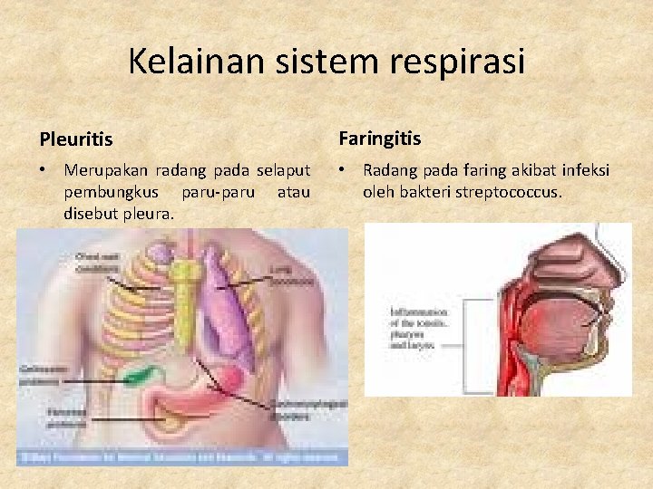 Kelainan sistem respirasi Pleuritis Faringitis • Merupakan radang pada selaput pembungkus paru-paru atau disebut