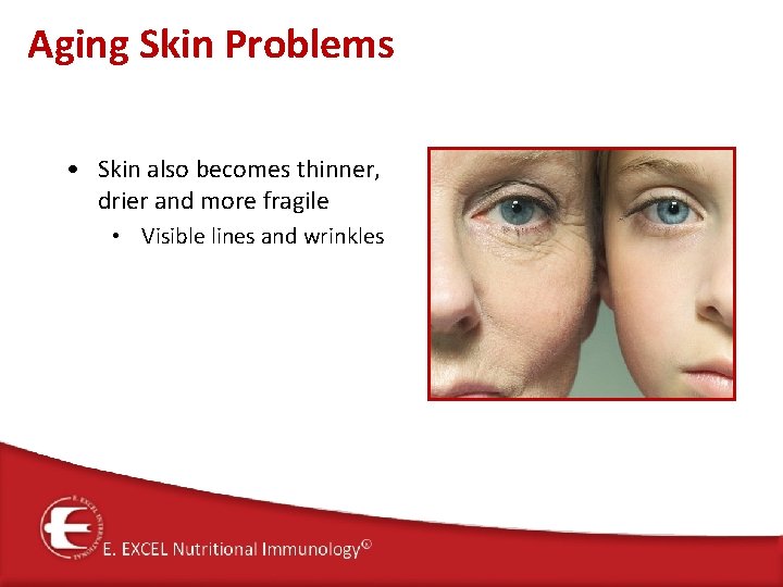 Aging Skin Problems • Skin also becomes thinner, drier and more fragile • Visible