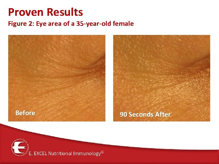 Proven Results Figure 2: Eye area of a 35 -year-old female Before 90 Seconds