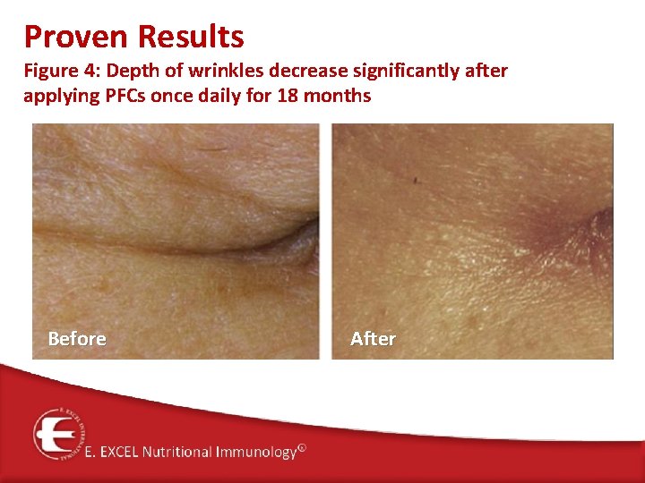 Proven Results Figure 4: Depth of wrinkles decrease significantly after applying PFCs once daily
