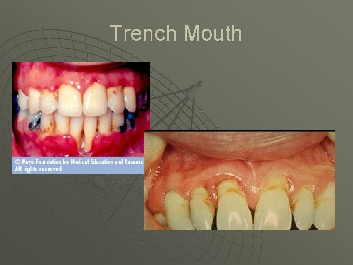 Trench Mouth Trench Mouth