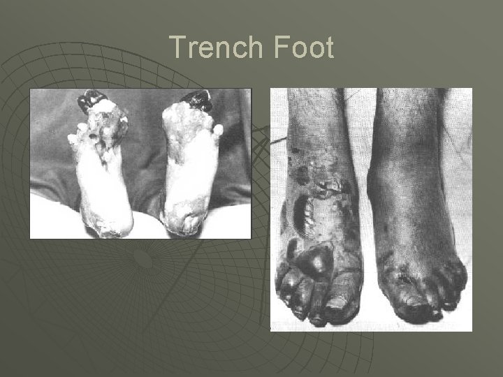 Trench Foot Trench Foot