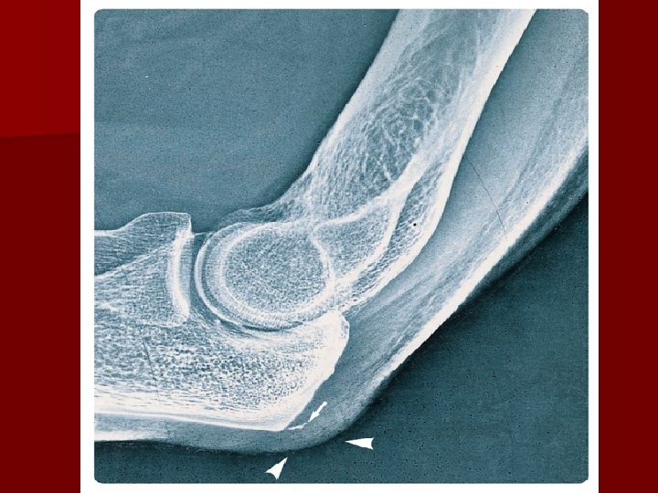dureri articulare la degetele de la picioare căderea părului simptome de slăbiciune a durerii articulare