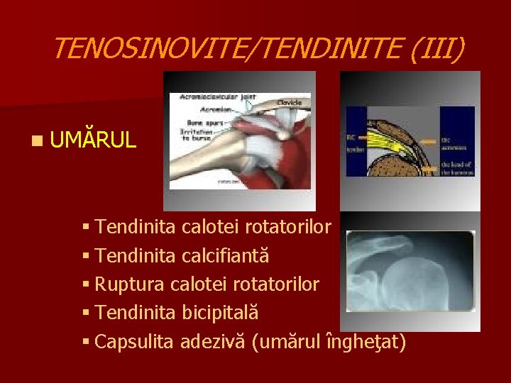 CURA INSTABILITATII TENDOANELOR PERONIERE