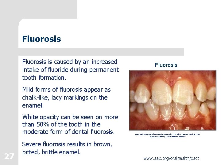 Fluorosis is caused by an increased intake of fluoride during permanent tooth formation. Fluorosis Fluorosis is caused by an increased intake of fluoride during permanent tooth formation. Fluorosis