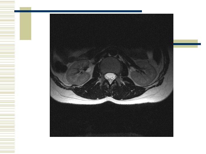 RED FLAGS CAUDA EQUINA Stuart Fraser Physiotherapist Wessex