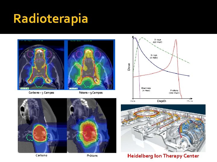 Radioterapia Carbono – 3 Campos Carbono Fótons – 9 Campos Prótons Heidelberg Ion Therapy