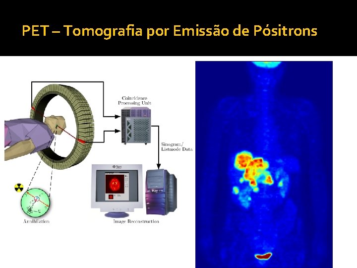 PET – Tomografia por Emissão de Pósitrons 