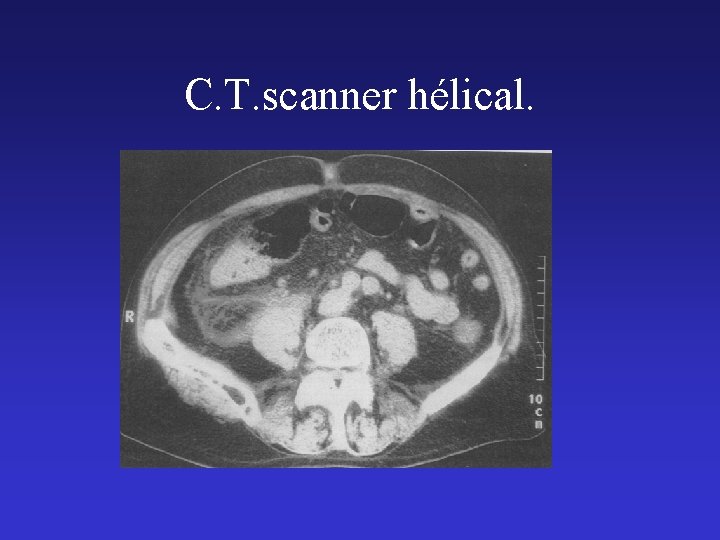 C. T. scanner hélical. 