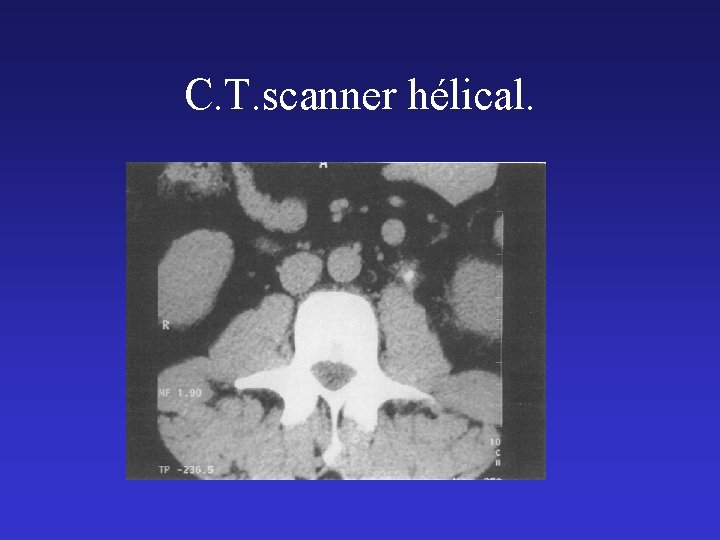 C. T. scanner hélical. 