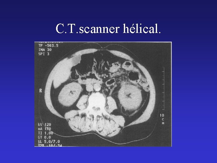 C. T. scanner hélical. 