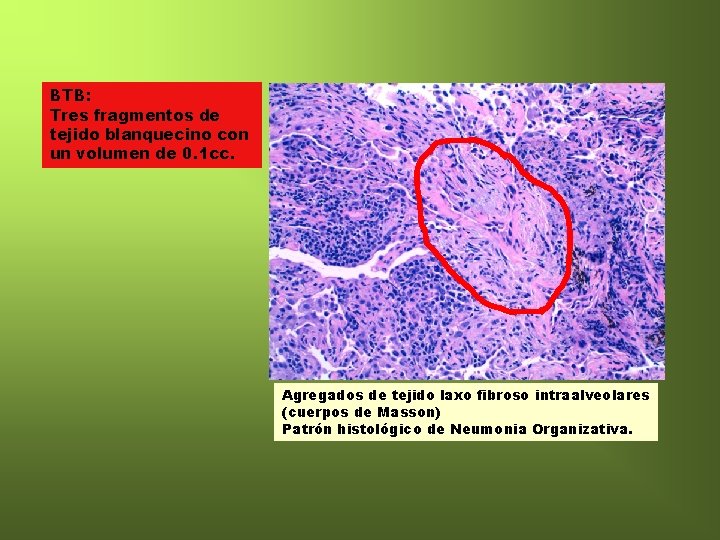 BTB: Tres fragmentos de tejido blanquecino con un volumen de 0. 1 cc. Agregados