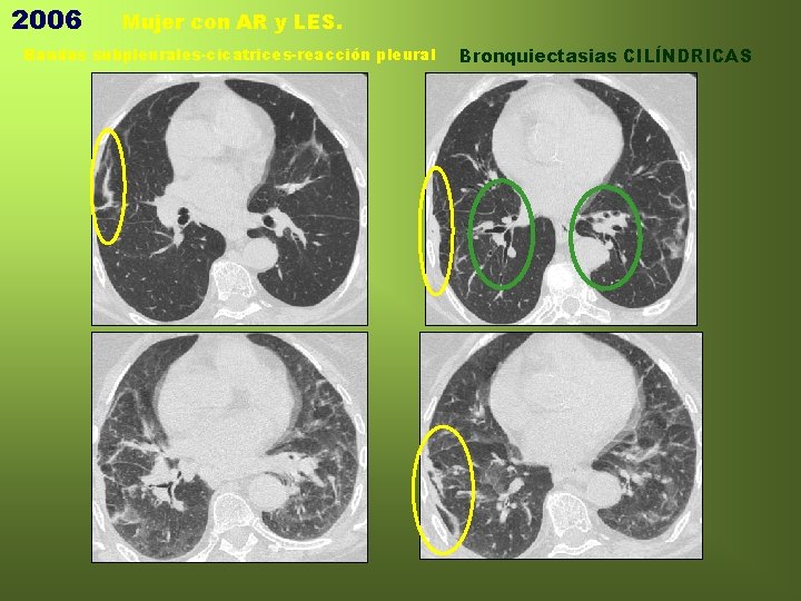 2006 Mujer con AR y LES. Bandas subpleurales-cicatrices-reacción pleural Bronquiectasias CILÍNDRICAS 