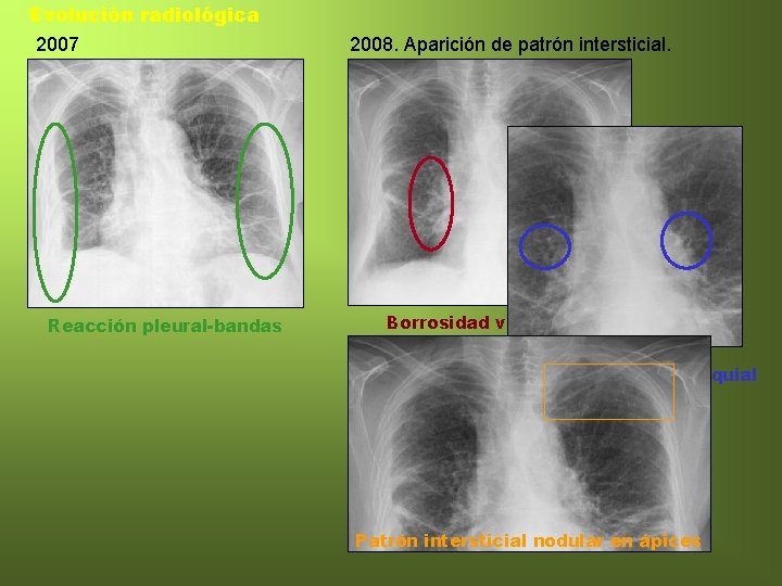 Evolución radiológica 2007 Reacción pleural-bandas 2008. Aparición de patrón intersticial. Borrosidad vascular Engrosamiento pared