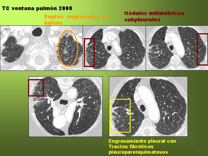 TC ventana pulmón 2008 Septos engrosados en ápices Nódulos milimétricos subpleurales Engrosamiento pleural con