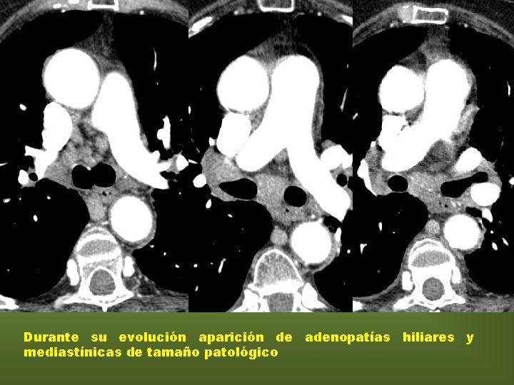 TC 2008 Durante su evolución aparición de adenopatías hiliares y mediastínicas de tamaño patológico