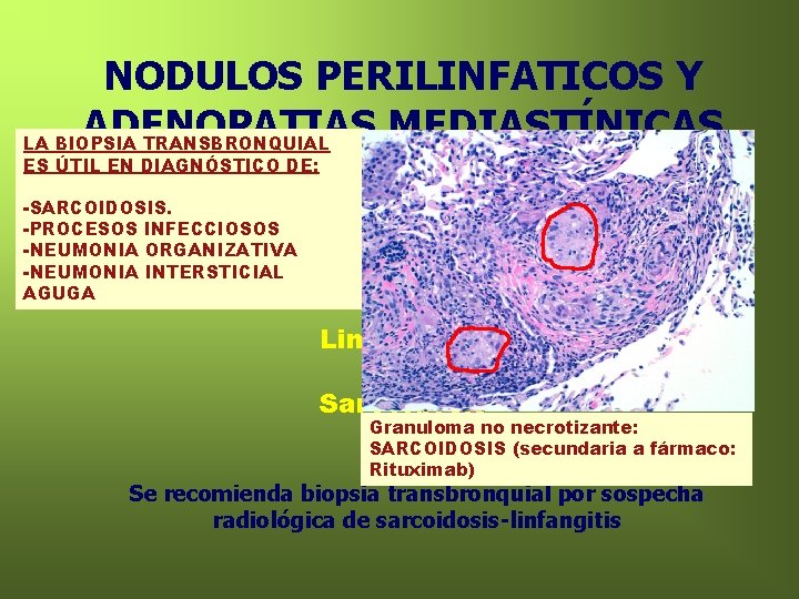 NODULOS PERILINFATICOS Y ADENOPATIAS MEDIASTÍNICAS LA BIOPSIA TRANSBRONQUIAL ES ÚTIL EN DIAGNÓSTICO DE: Ante