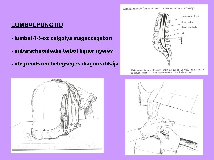 LUMBALPUNCTIO - lumbal 4 -5 -ös csigolya magasságában - subarachnoidealis térből liquor nyerés -