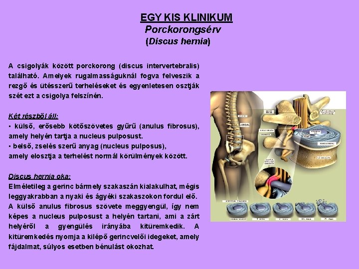 EGY KIS KLINIKUM Porckorongsérv (Discus hernia) A csigolyák között porckorong (discus intervertebralis) található. Amelyek