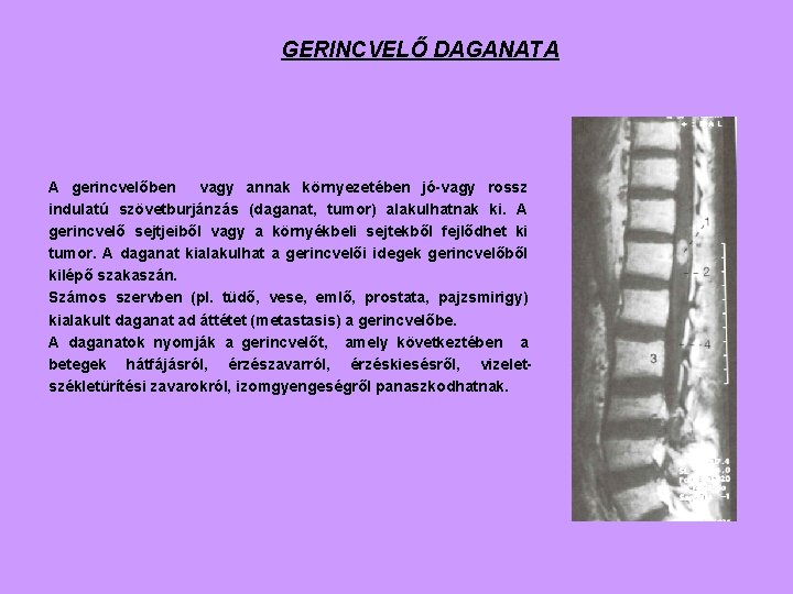 GERINCVELŐ DAGANATA A gerincvelőben vagy annak környezetében jó-vagy rossz indulatú szövetburjánzás (daganat, tumor) alakulhatnak
