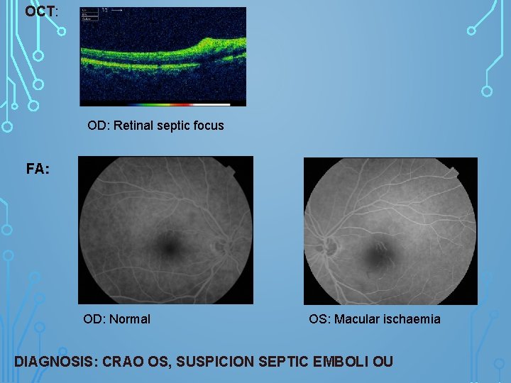 OCT: OD: Retinal septic focus FA: OD: Normal OS: Macular ischaemia DIAGNOSIS: CRAO OS,