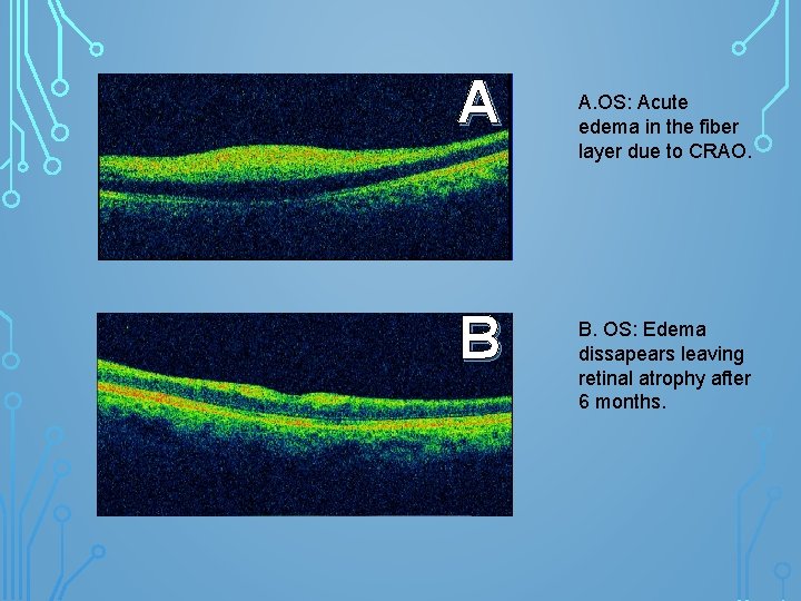 A B A. OS: Acute edema in the fiber layer due to CRAO. B.