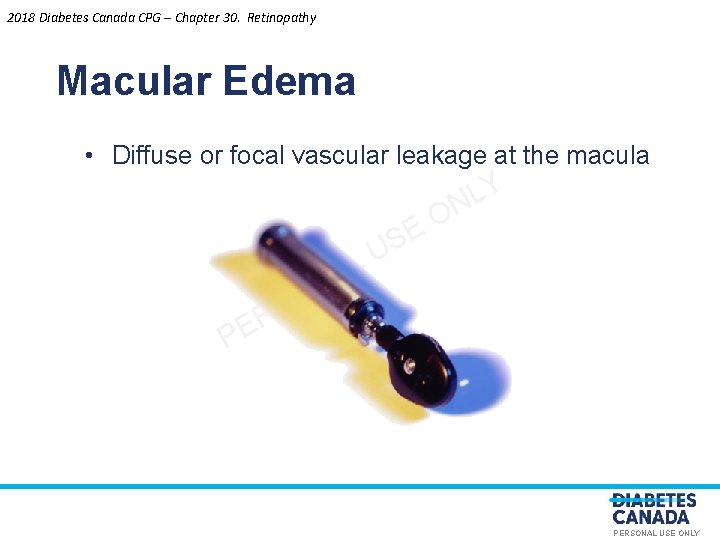 2018 Diabetes Canada CPG – Chapter 30. Retinopathy Macular Edema • Diffuse or focal